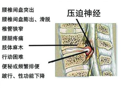 腰椎间盘突出症中微创护理新技巧